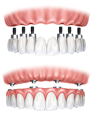 Dental Implants Materials in Shillington